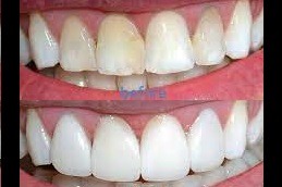 E-Max Veneers Clinic in Dubai