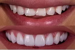 E-Max Veneers Dubai
