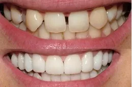 E-Max Veneers in Abu Dhabi