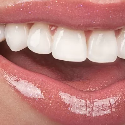 E-Max Veneers in Dubai & Abu Dhabi UAE Veneers Cost & Price