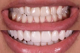 E-Max Veneers in Dubai