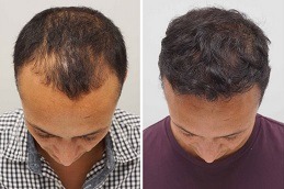 FUSS Hair Transplant Clinic in Abu Dhabi