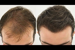 FUSS Hair Transplant Clinic in Dubai
