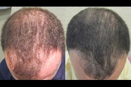 FUSS Hair Transplant Dubai & Abu Dhabi