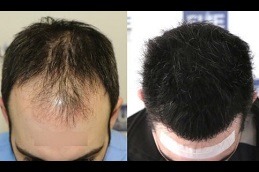 FUSS Hair Transplant Dubai