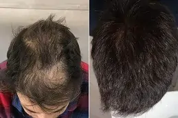 FUSS Hair Transplant in Abu Dhabi