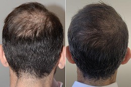 FUSS Hair Transplant in Dubai