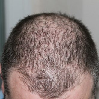 FUT Hair Transplant Cost in Dubai & Abu Dhabi