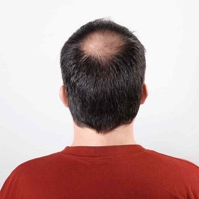 Fuss Hair Transplant in Dubai & Abu Dhabi Fuss Transplant Cost