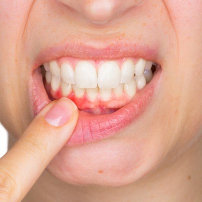 Gum Bleeding Treatment in Dubai & Abu Dhabi Gum Diseases Price