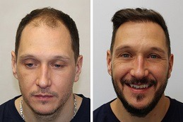 Hair Transplant Ras Al Khaimah