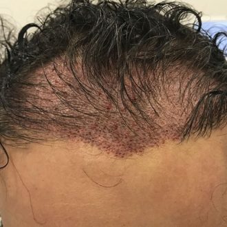 Hair Transplant Without Shaving in Dubai