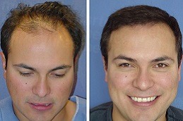 Hair Transplant in Ras Al Khaimah UAE