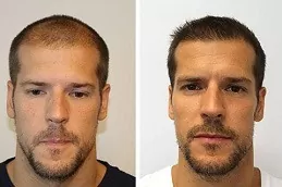 Hair Transplant in Ras Al Khaimah