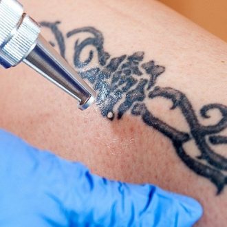Laser Tattoo Removal Cost in Dubai