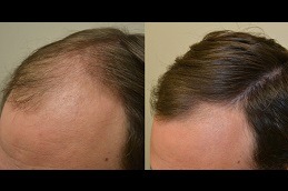 Natural Hairline Treatment Abu Dhabi
