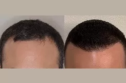 Natural Hairline Treatment Clinic in Abu Dhabi
