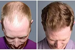 Natural Hairline Treatment Clinic in Dubai