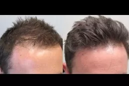 Natural Hairline Treatment Dubai