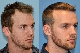Natural Hairline Treatment in Abu Dhabi