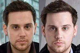 Natural Hairline Treatment in Dubai