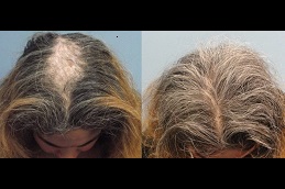 PRP Hair Treatment Cost in Dubai 