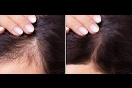 PRP Hair Treatment Cost in Dubai