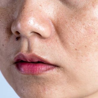 Pigmentation Treatment Cost in Dubai & Abu Dhabi