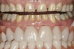 Porcelain Dental Veneers Clinic Abu Dhabi