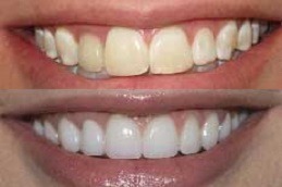 Porcelain Dental Veneers Clinic Dubai & Abu Dhabi