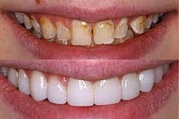 Porcelain Dental Veneers Clinic Dubai