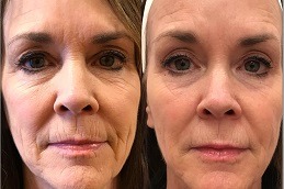 Radiesse Filler Injections Clinic in Abu Dhabi