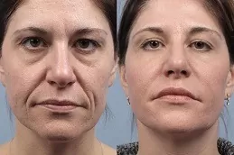 Radiesse Filler Injections Clinic in Dubai