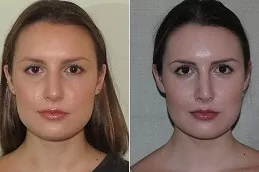 Septoplasty and Turbinate Reduction in Dubai