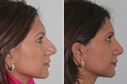 Septoplasty and Turbinate Reduction Dubai