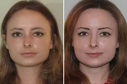 Septoplasty and Turbinate Reduction