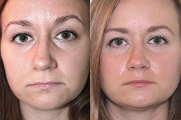Septoplasty and Turbinate Reduction treatment in Dubai