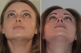Septoplasty and Turbinate Reduction