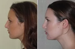 Septoplasty and Turbinate Reduction in Dubai