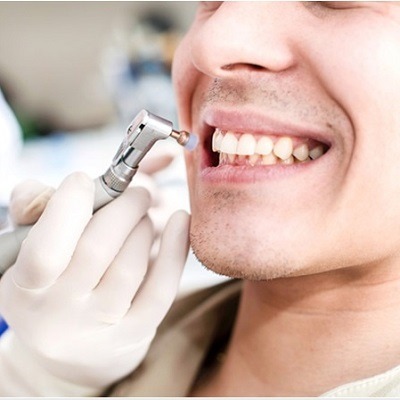 Teeth Polishing & Scaling in Dubai & Abu Dhabi Teeth Polishing Cost