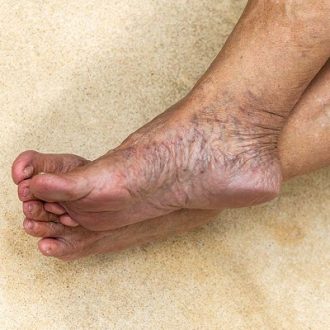 Varicose Veins Treatment Cost Dubai & Abu Dhabi