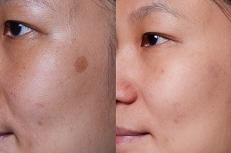 Actinic Keratosis Treatment Abu Dhabi