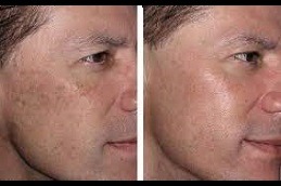 Actinic Keratosis Treatment Clinic in Abu Dhabi