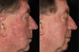 Actinic Keratosis Treatment Clinic in Dubai