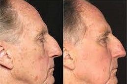 Actinic Keratosis Treatment Dubai