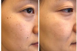 Actinic Keratosis Treatment in Abu Dhabi