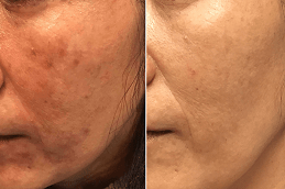 Actinic Keratosis Treatment in Dubai