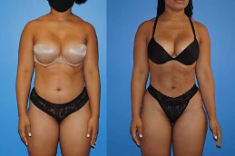 BRAVA Breast Augmentation Abu Dhabi