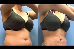 BRAVA Breast Augmentation Clinic in Dubai