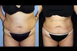 BRAVA Breast Augmentation in Abu Dhabi